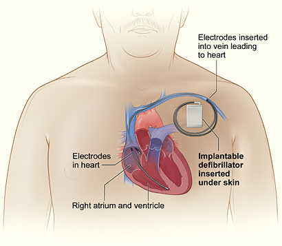 implantable cardioverter defibrillator