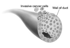 invasive duct cancer