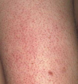 keratosis pilaris on the upper arm