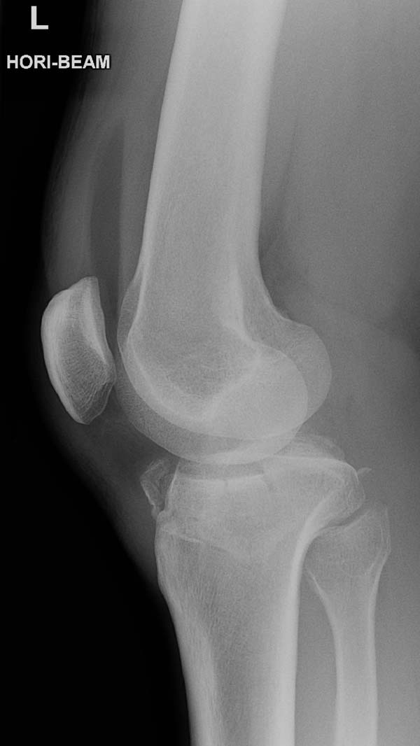 X-ray of the knee joint