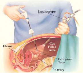 laparoscopy procedure