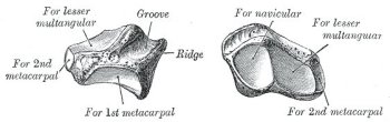 left greater multangular bone