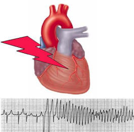 long QT syndrome