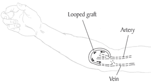 looped graft for dialysis
