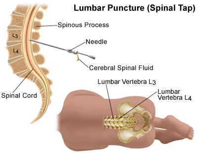 lumbar puncture