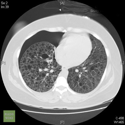 CT image of a patient's lungs with lymphangioleiomyomatosis
