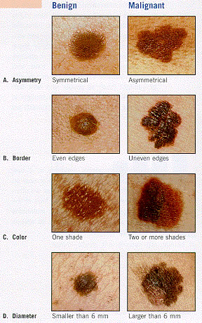 melanomas