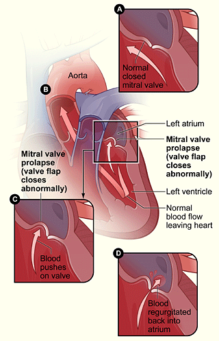 mitral valve prolapse