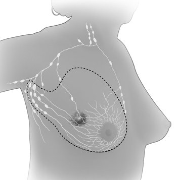 modified radical masectomy