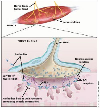 mysasthenia gravis