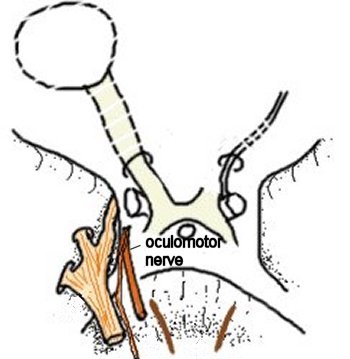 oculomotor nerve