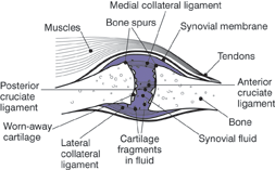 osteoarthritic joint