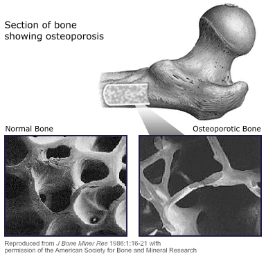 osteoporosis