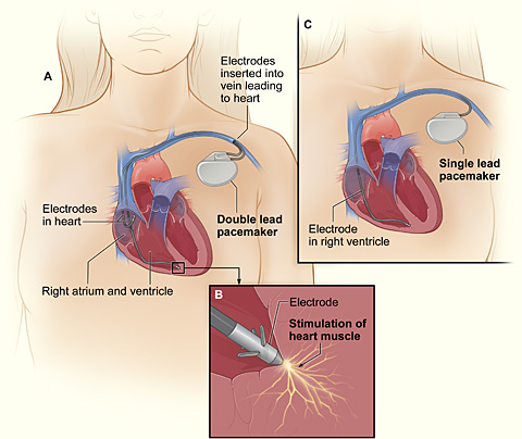 pacemaker diagram
