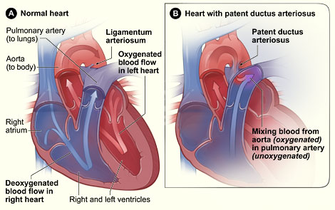patent ductus arteriosus