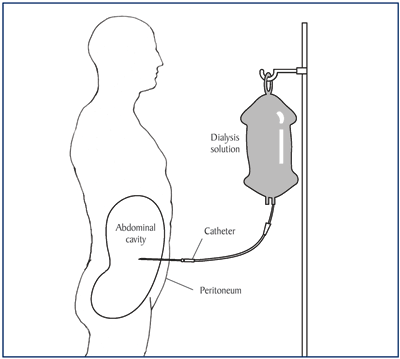 peritoneal dialysis