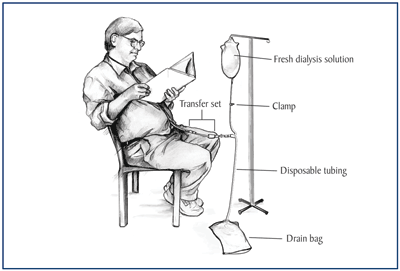 peritoneal dialysis transfer set