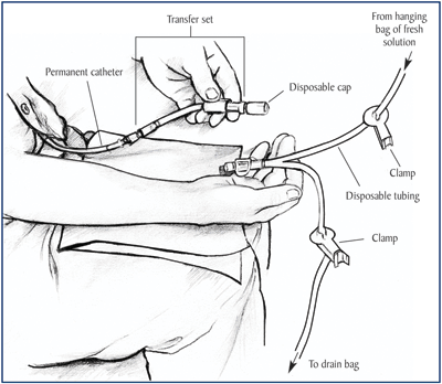 peritoneal dialysis transfer set