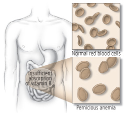 pernicious anemia