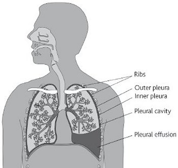 pleural effusion