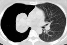 CT scan of right lung pneumothorax