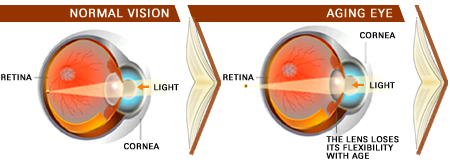 presbyopia