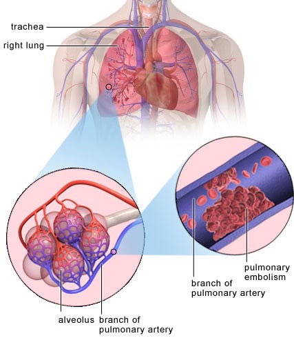 pulmonary embolism