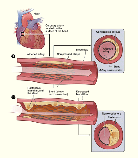 restenosis of stent-widened coronary artery