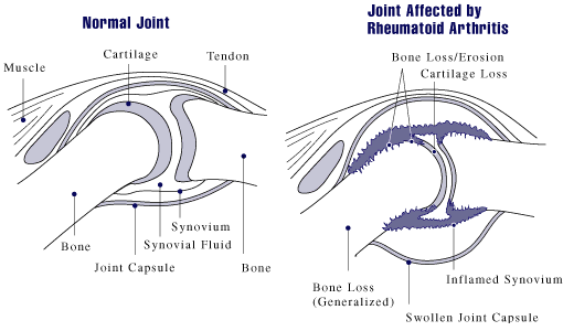 Normal joint and joint affected by rheumatoid arthritis