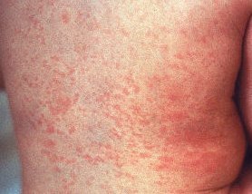 rubella rash