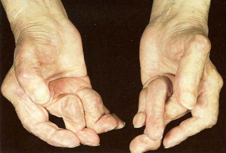 severly arthritic hands