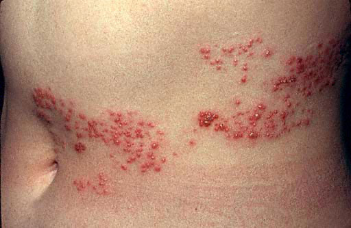 shingles rash