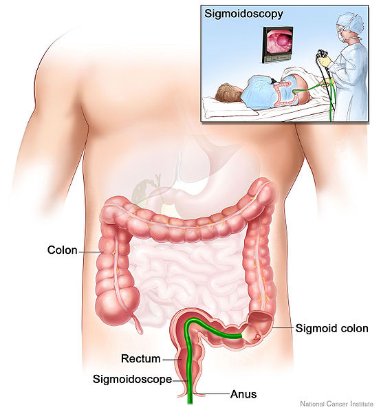 sigmoidoscopy