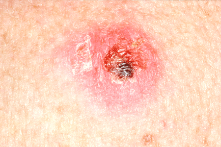 Sore or lump that bleeds or develops a crust or a scab