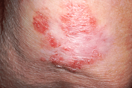 Flat red spot that is rough, dry, or scaly and may become itchy or tender