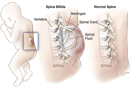 spina bifida