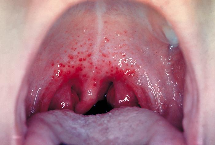 strep throat