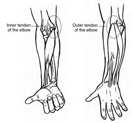 tennis elbow