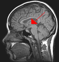 thalamus. Image: Wikipedia