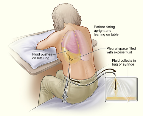 thoracentesis