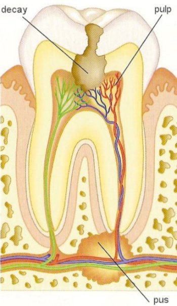 dental abscess