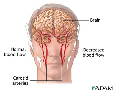 transient ischemic attack