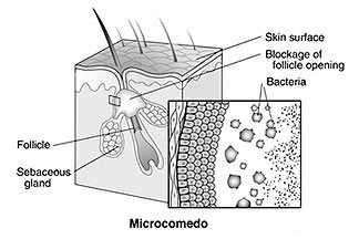 microcomedo