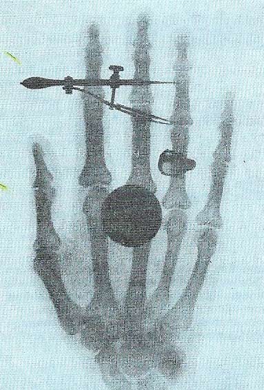 Marie Curie's hand photographed using a gamma-ray source