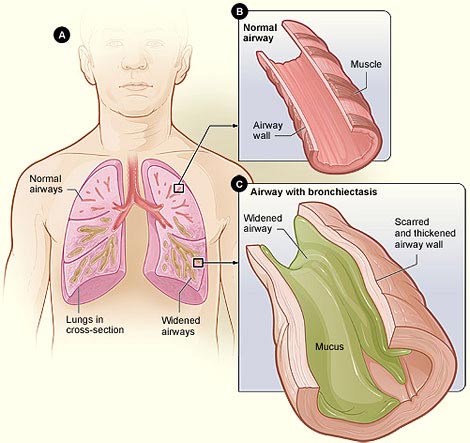 Fig A shows a cross-section of the lungs with normal airways and widened airways. Fig B shows a cross-section of a normal airway. Fig C shows a cross-section of an airway with bronchiectasis.