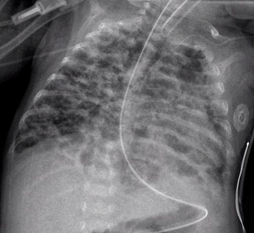 A chest radiograph of bronchopulmonary dysplasia.