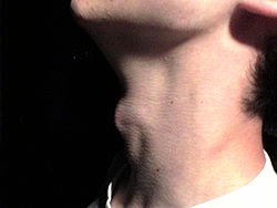 Example of an Adam's apple