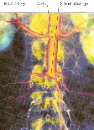 arterial thrombosis