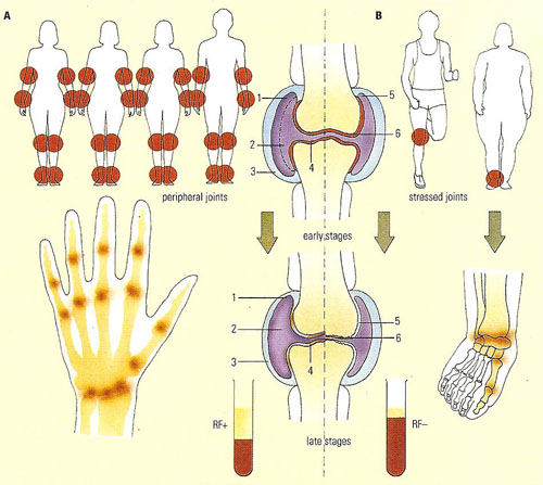 types of arthritis