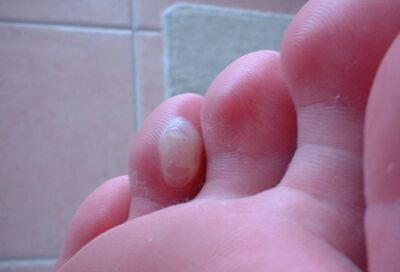 blister on a toe
